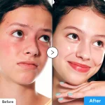 قبل و بعد سرم آبرسان اکوال بری