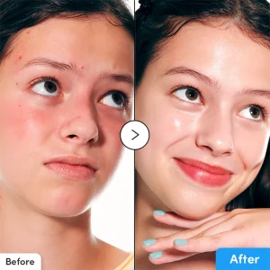 قبل و بعد سرم آبرسان اکوال بری